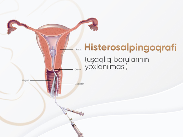 Histeroskopiya: histeroskopla poliplərin və miomaların götürülməsi və s.